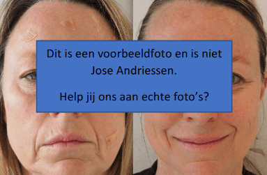 Voor en na multi collageen