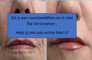 Voor en na multi collageen
